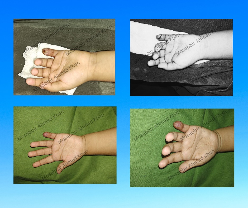 ৫ বছরের ছোট্ট বাচ্চাটি তার মায়ের সাথে এসেছিল দুর্ঘটনার প্রায় ১ মাস পর।